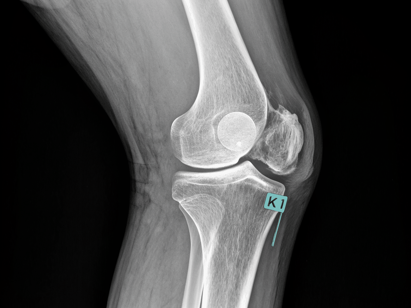 Pianificazione radiografica pre-operatoria