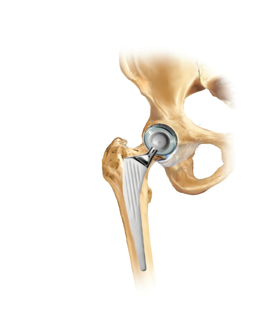 Modello anatomico di articolazione dell'anca